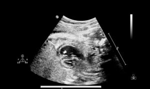 What Can an Abdominal Ultrasound Detect? A Simple Guide